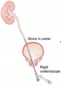 输尿管硬镜手术视频,输尿管硬镜手术操作步骤及技巧解析